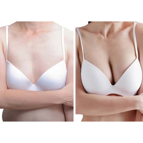 Avant et après les implants mammaires