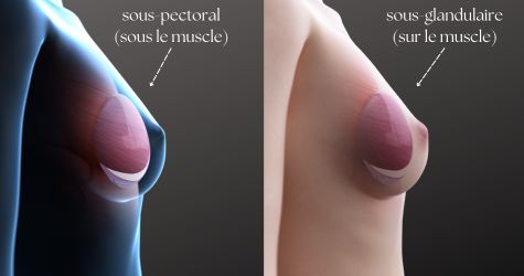 menu placement d'implants mammaires