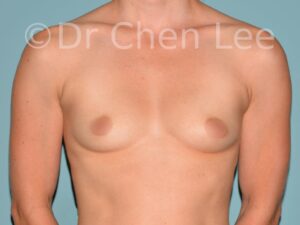 augmentation-mammaire-avant-apres-01-01-avant-implant-front