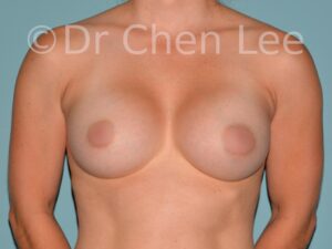 augmentation-mammaire-avant-apres-01-02-apres-implant-front